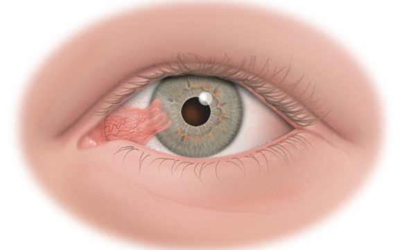 Cirugía de ojos para mejorar tu visión y dejar de usar lentes, Inicio, Clinica Sancho