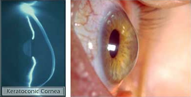 Queratocono