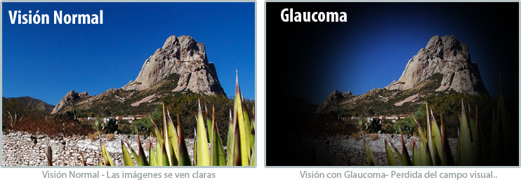 Visión con glaucoma