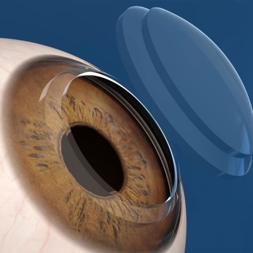 trasplante-cornea