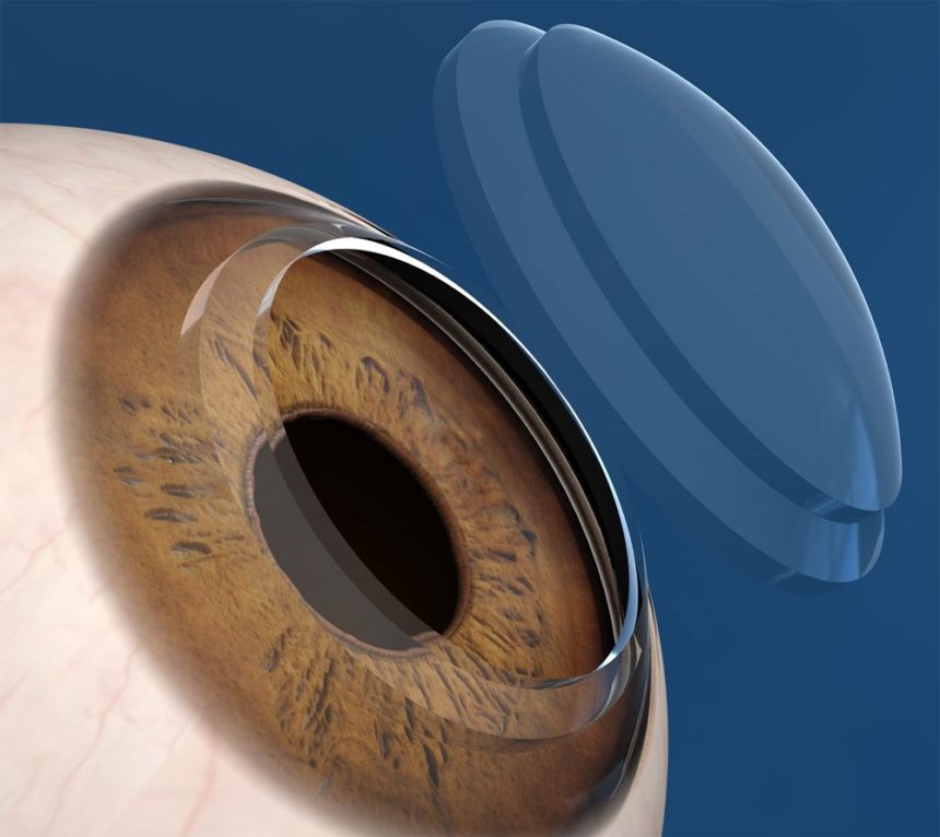 Cornea Transplant Surgery In Ecuador Clinica Sancho