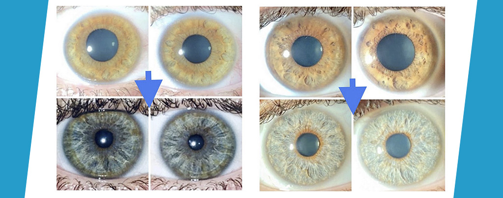 Laser procedure can turn brown eyes blue