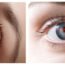 Peligros del cambio de color de los ojos con la queratopigmentación