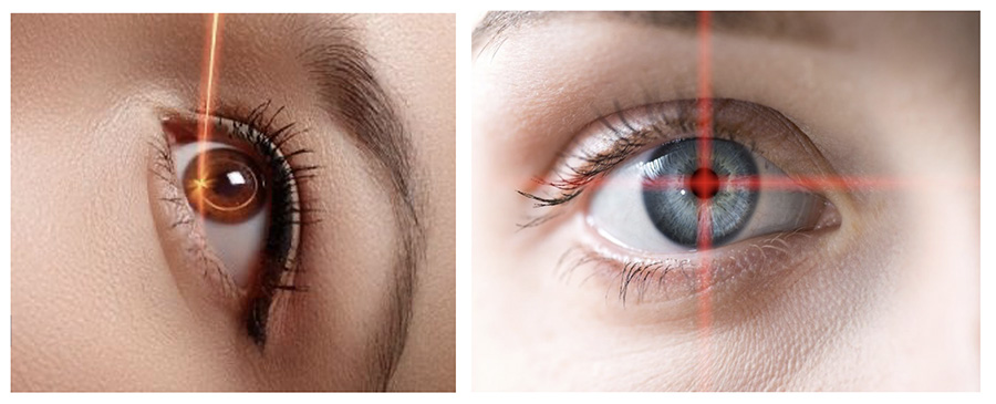 Dangers of eye color change with keratopigmentation