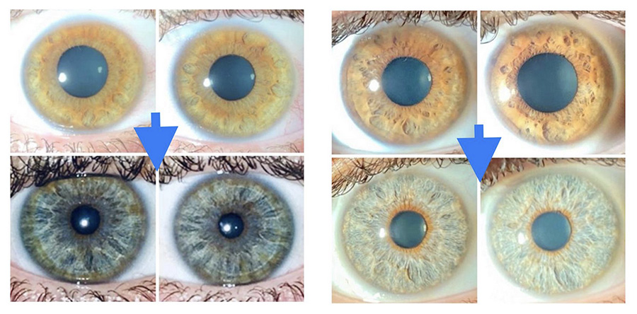 Dangers of eye color change with keratopigmentation